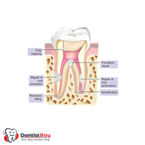 MTA Plus, Endodontic Cement by Prevest DenPro MTA Plus, Endodontic Cement by Prevest DenPro