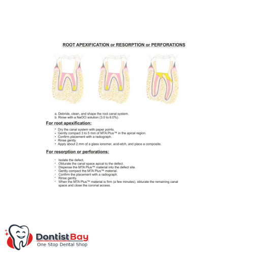 MTA Plus, Endodontic Cement by Prevest DenPro MTA Plus, Endodontic Cement by Prevest DenPro