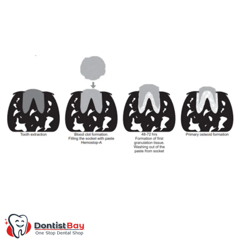 Socket Cure, Temporary Socket Dressing Paste by SafeEndo